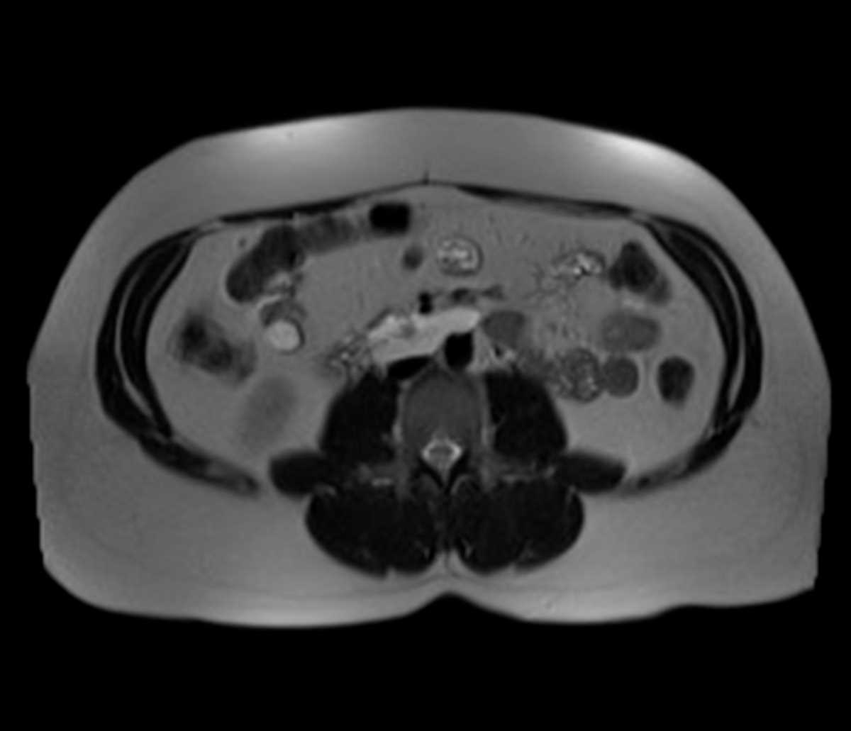 Lymphangioma - CTisus CT Scan