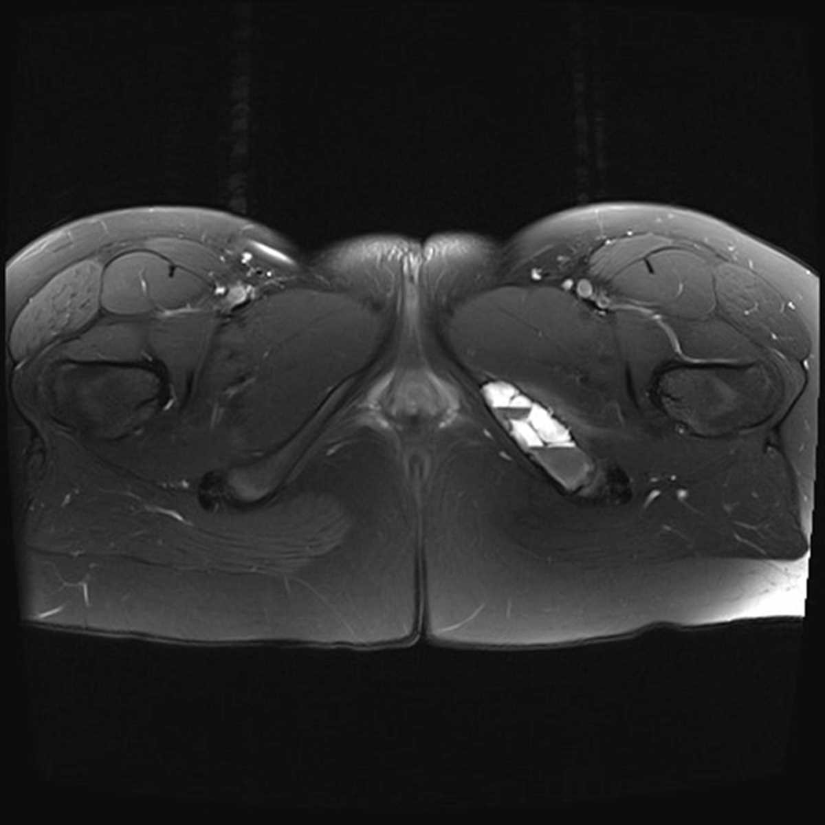 Aneurysmal Bone Cyst - CTisus CT Scan