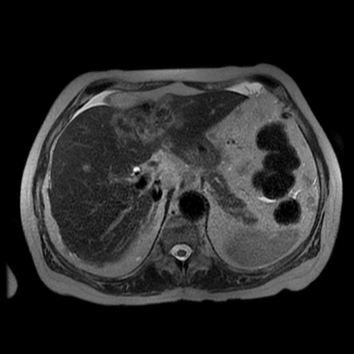 Cholangiocarcinoma - CTisus CT Scan