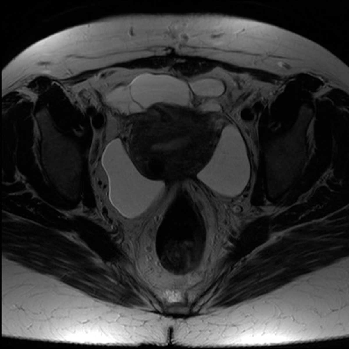 Peritoneal Inclusion Cysts - CTisus CT Scan