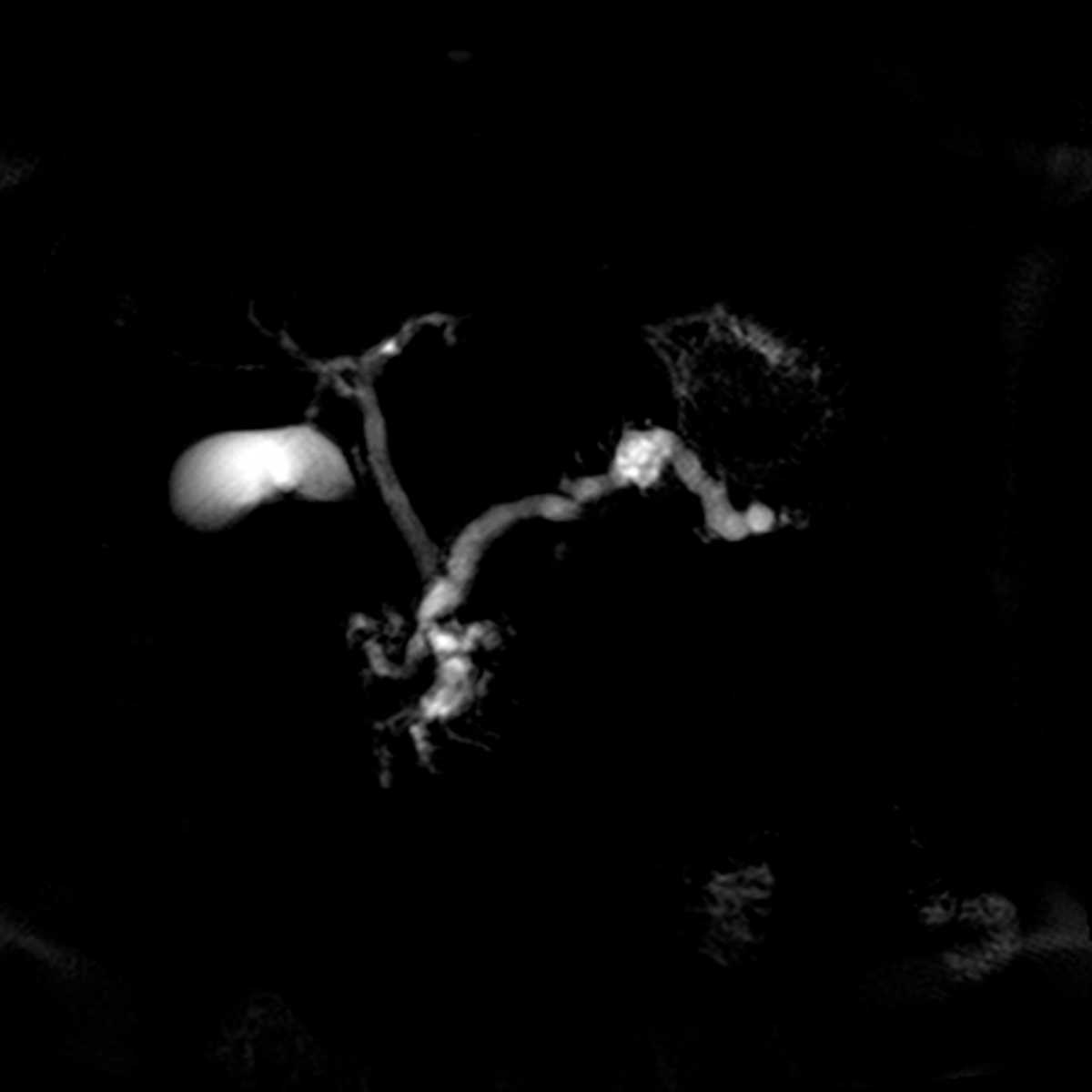 Main duct Intraductal Papillary Mucinous Neoplasm (IPMN) - CTisus CT Scan