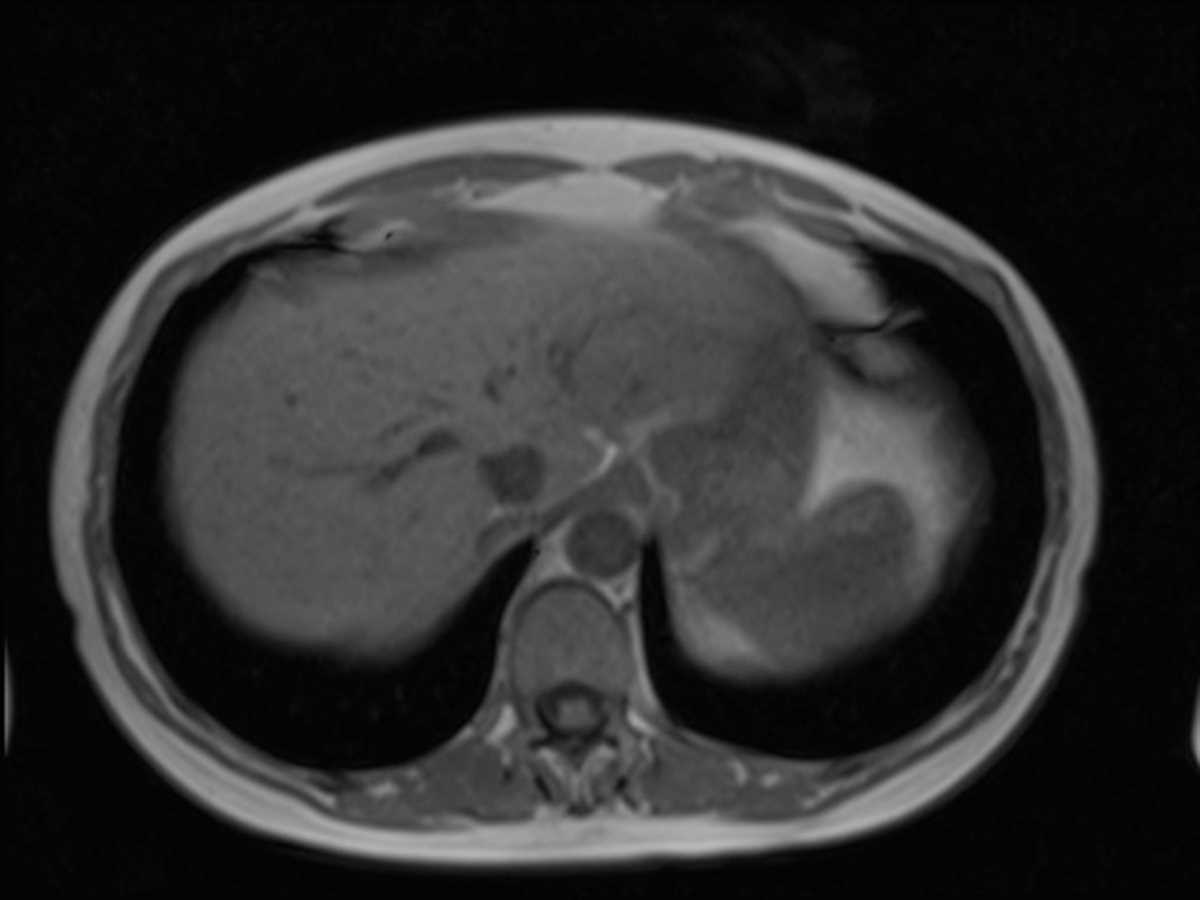 Hepatic Adenoma - Body MR Case Studies - CTisus CT Scanning