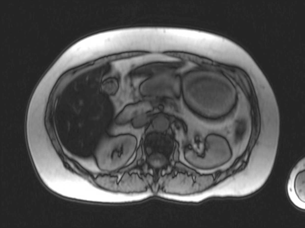 Hepatic Steatosis - CTisus CT Scan