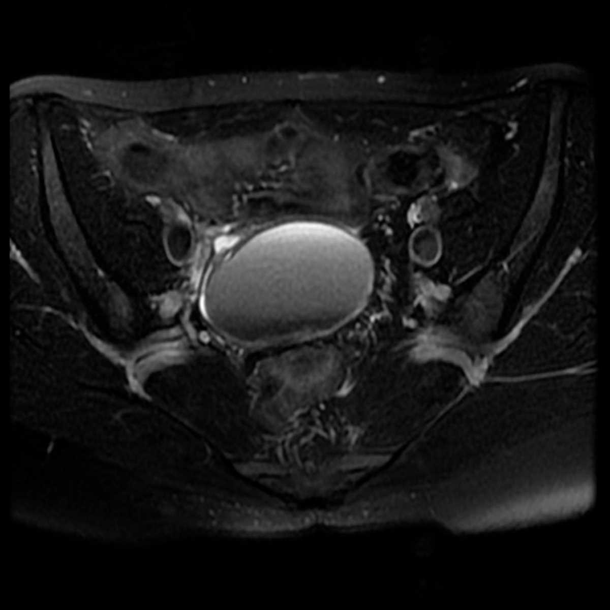 Endometrioma - CTisus CT Scan