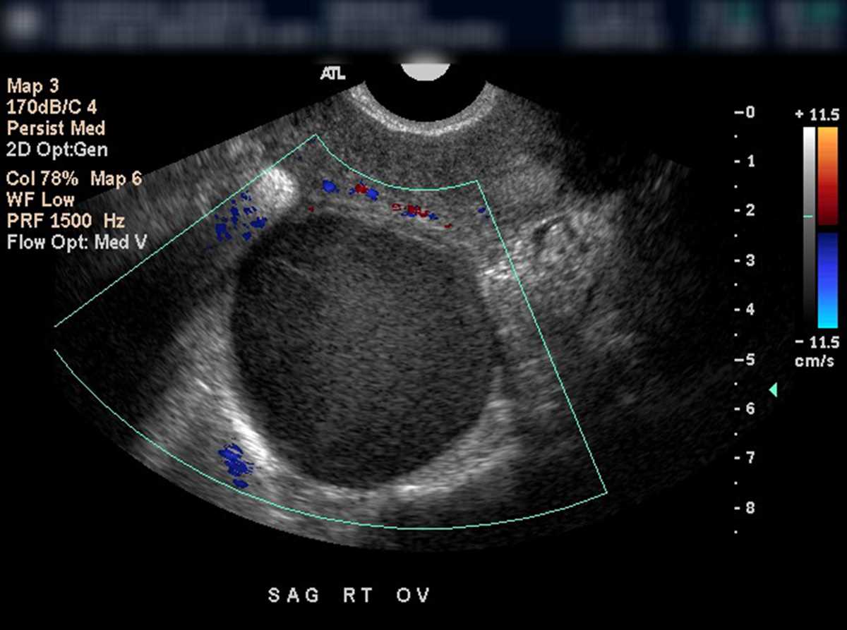 Endometrioma - Body MR Case Studies - CTisus CT Scanning