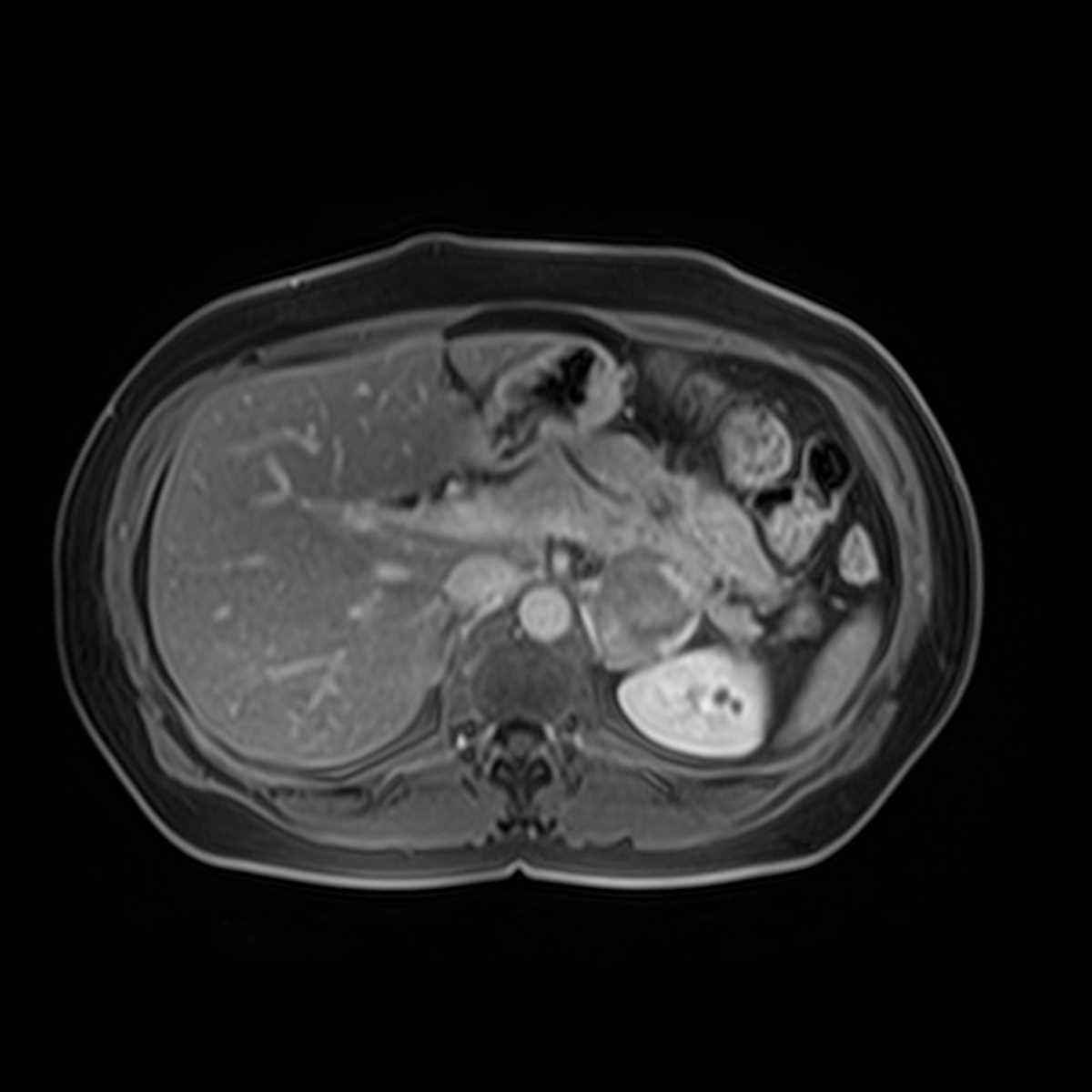 Pheochromocytoma - Body MR Case Studies - CTisus CT Scanning