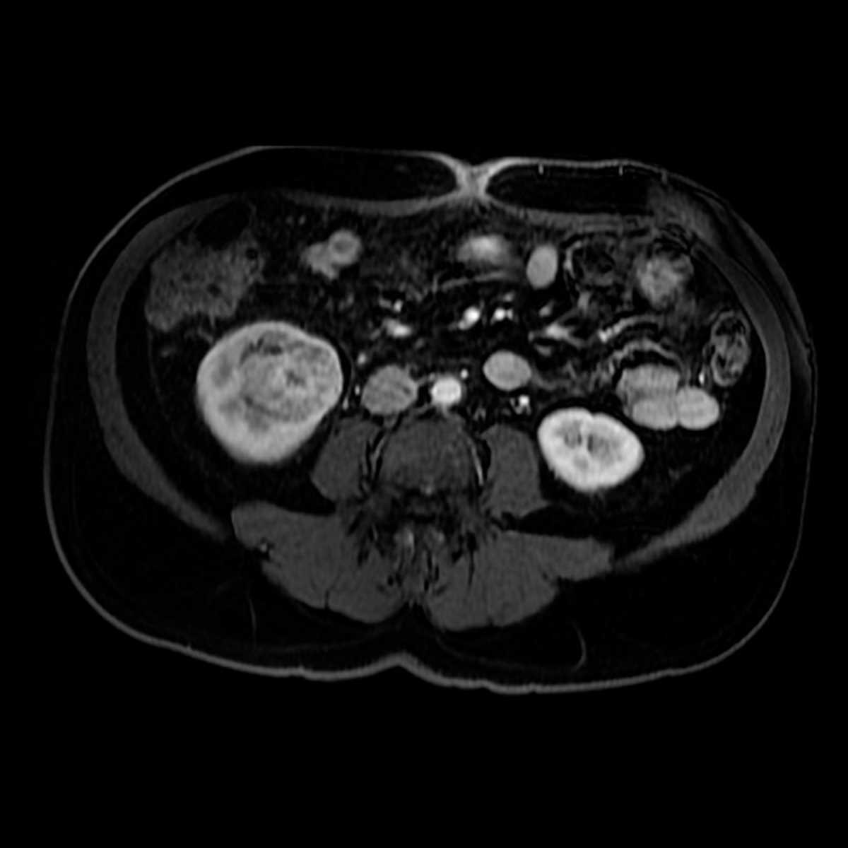 Oncocytoma - Body MR Case Studies - CTisus CT Scanning