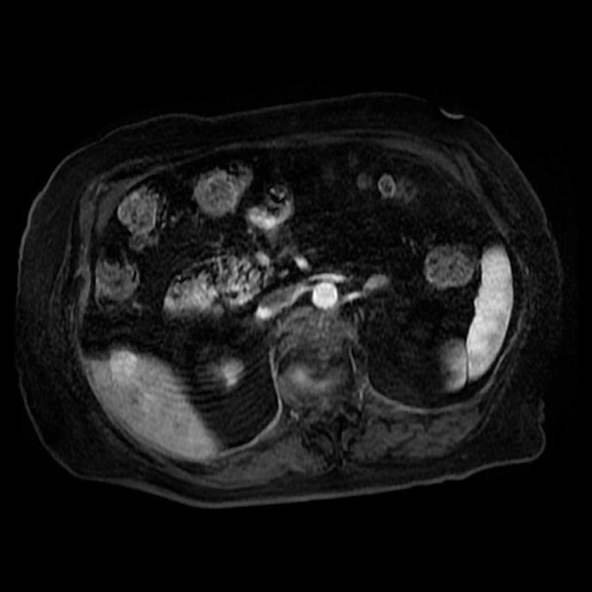 Melanoma - CTisus CT Scan