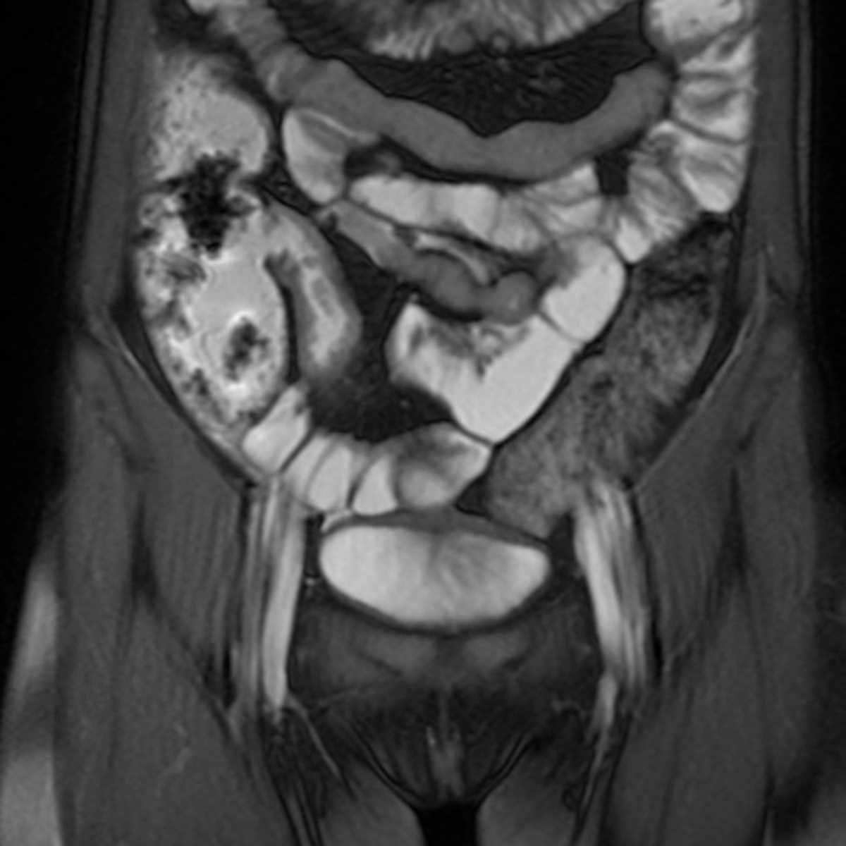 Crohn's Ileitis - CTisus CT Scan