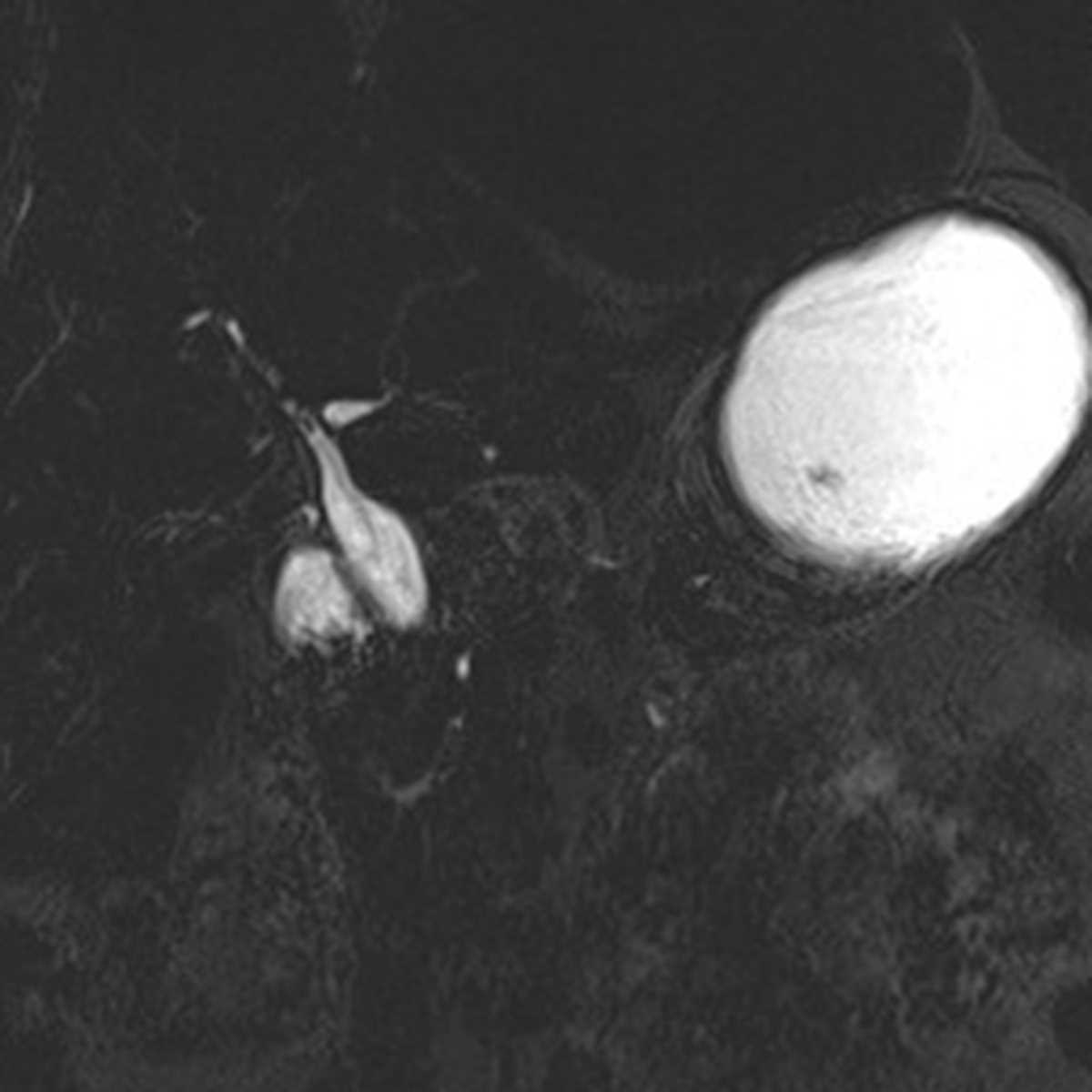 Type I choledochal cyst - CTisus CT Scan