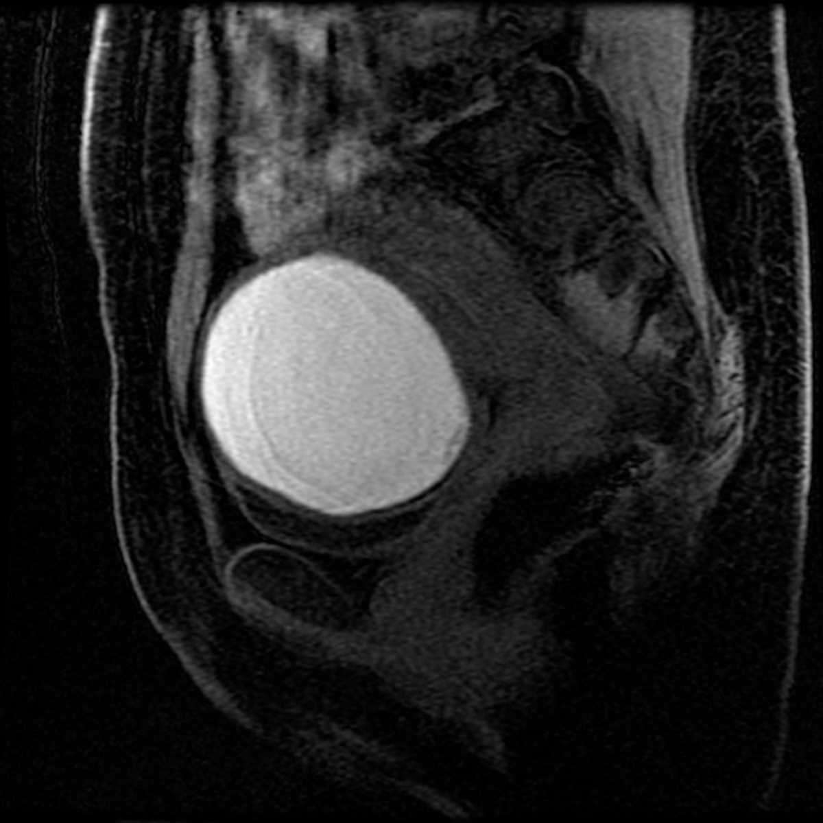 Endometrioma - CTisus CT Scan