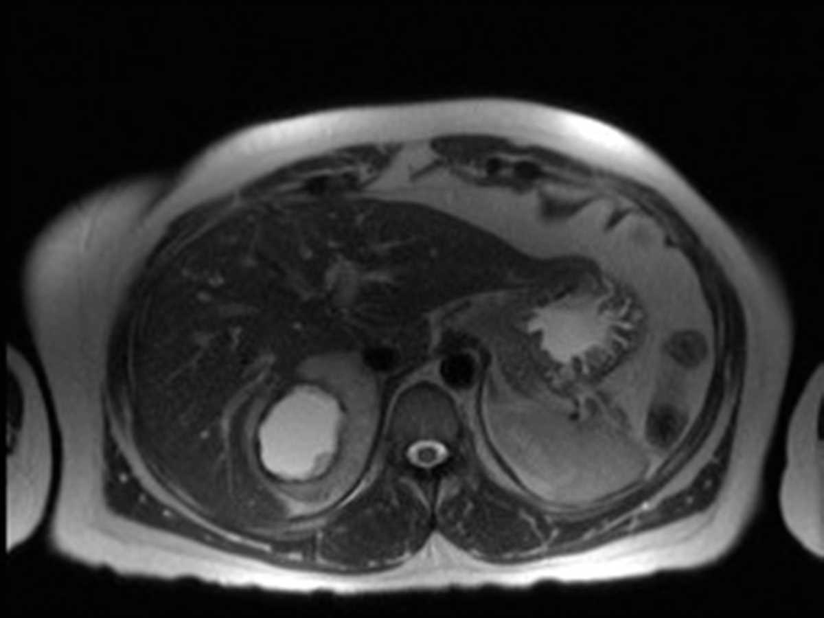 Pheochromocytoma - CTisus CT Scan