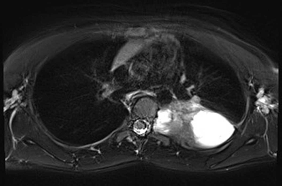 Posterior mediastinal ganglioneuroma - CTisus CT Scan