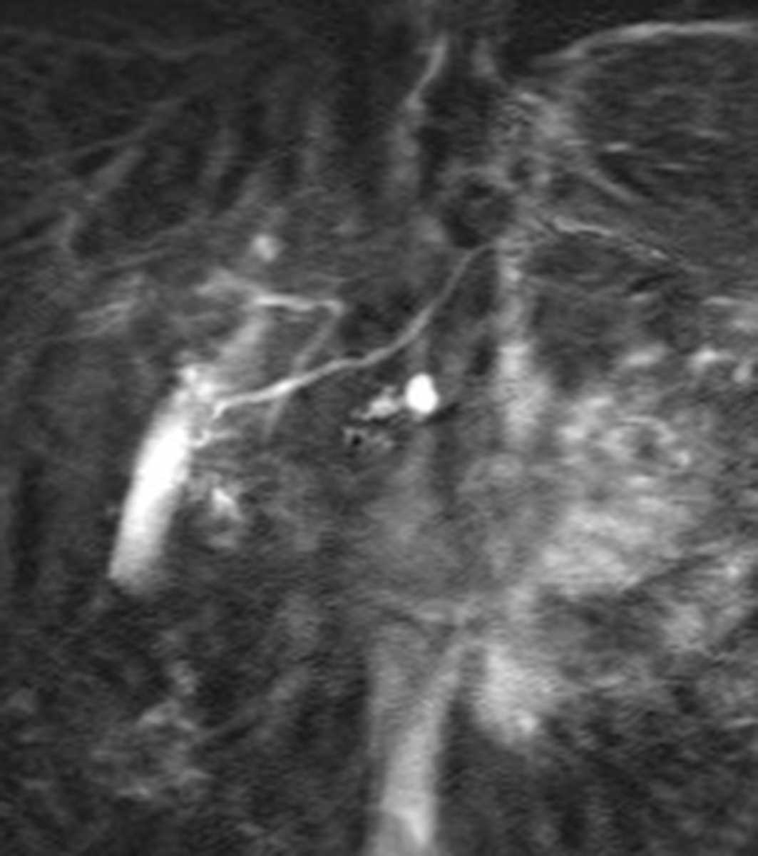 Pancreatic divisum - CTisus CT Scan