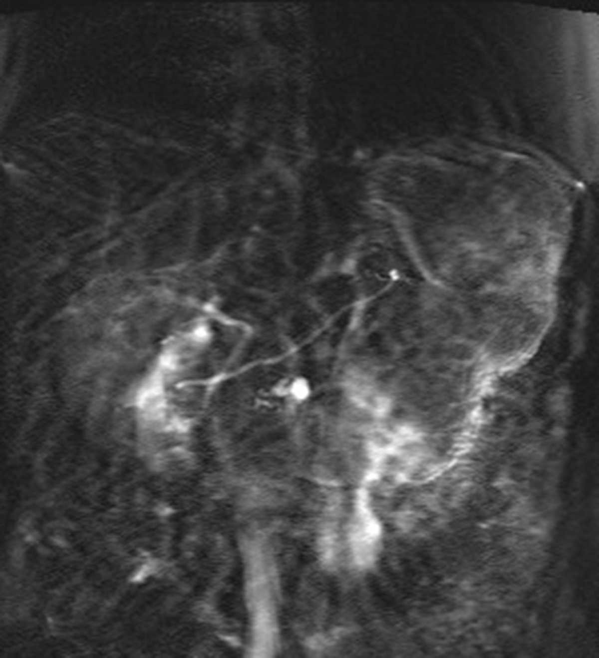 Pancreatic divisum - Body MR Case Studies - CTisus CT Scanning