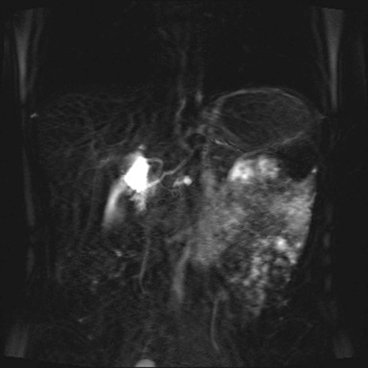 Pancreatic divisum - Body MR Case Studies - CTisus CT Scanning