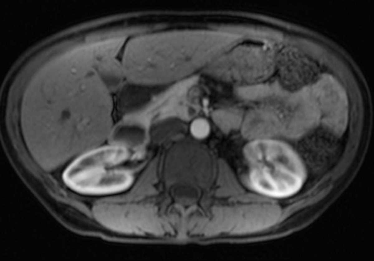 Pancreatic divisum - Body MR Case Studies - CTisus CT Scanning