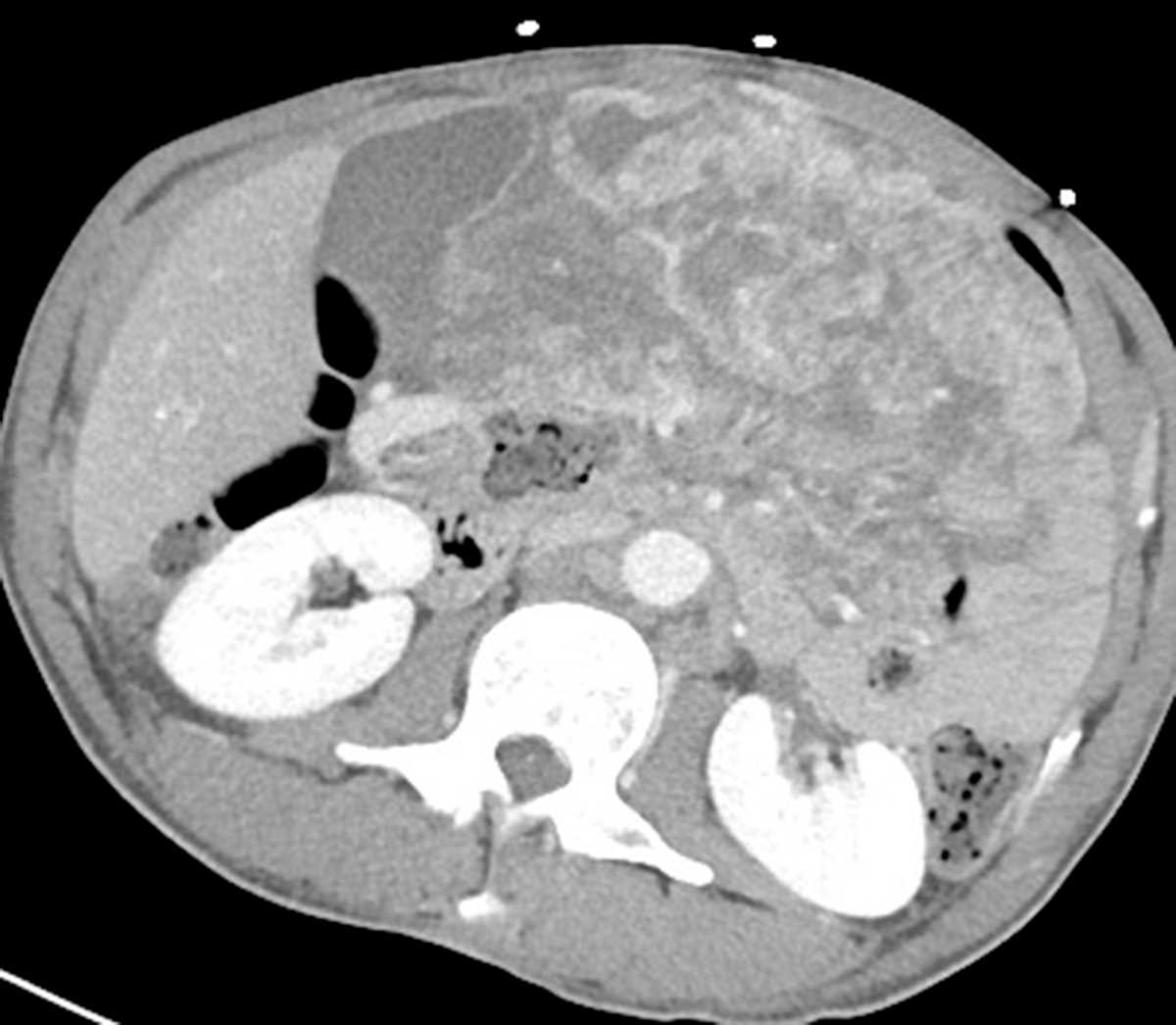 Large gastric GIST - CTisus CT Scan