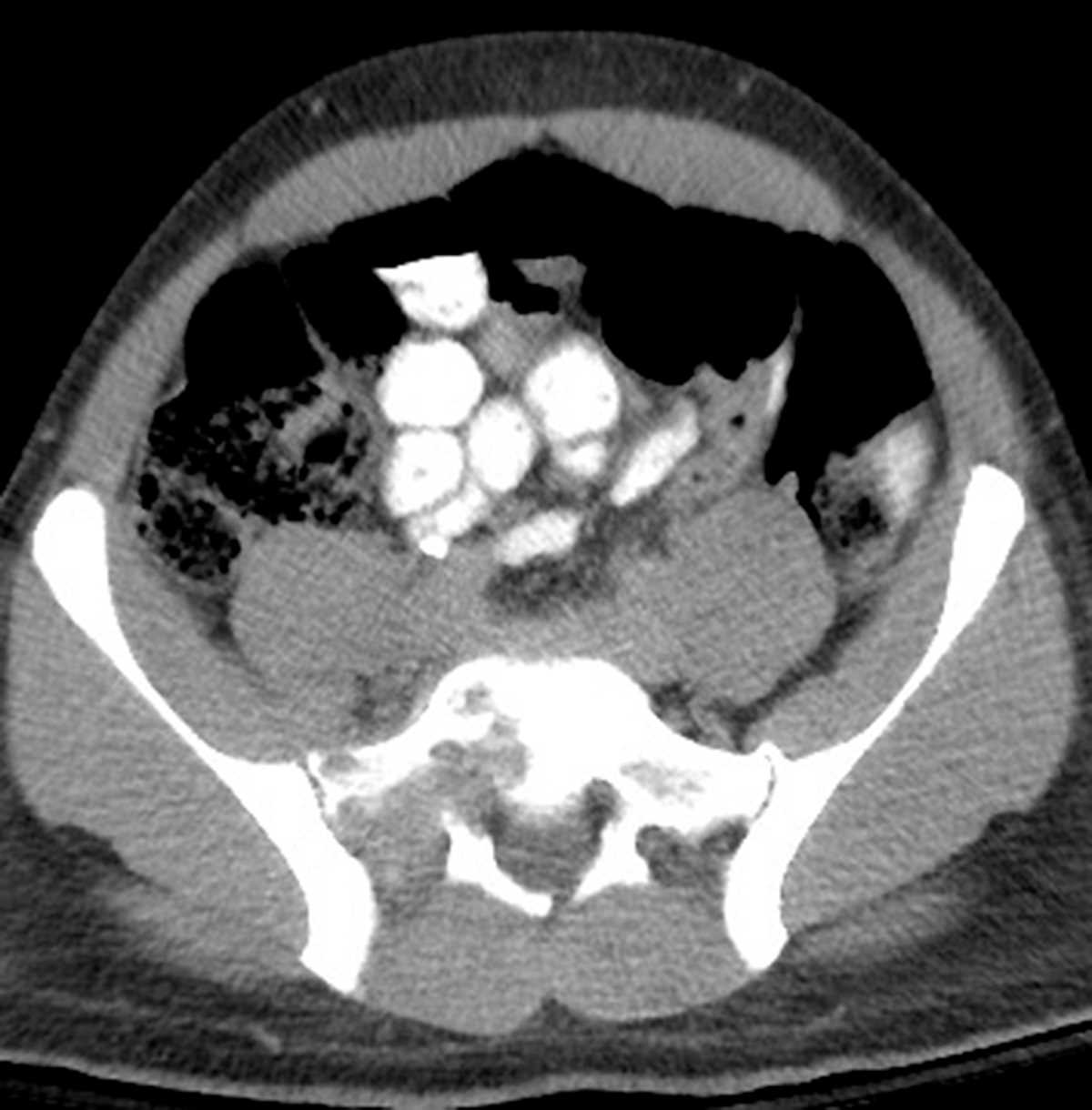 Sacral Lymphoma - CTisus CT Scan