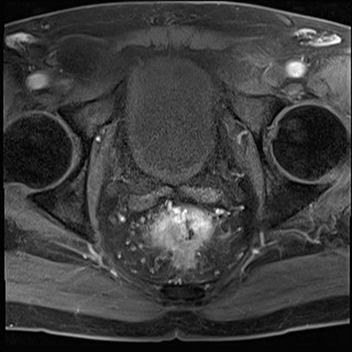 Rectal Cancer - CTisus CT Scan