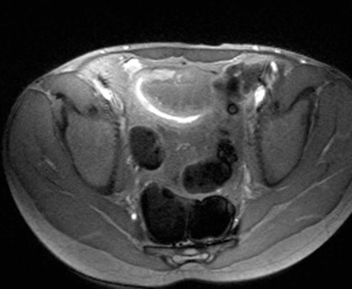 Crohn's disease - CTisus CT Scan