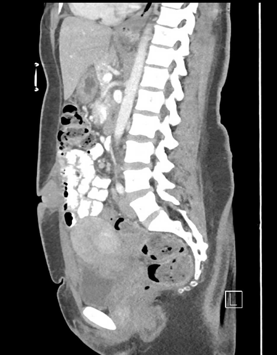 Endometrial implant in umbilicus - CTisus CT Scan
