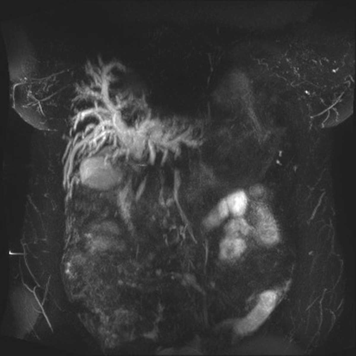 Gallbladder cancer - CTisus CT Scan