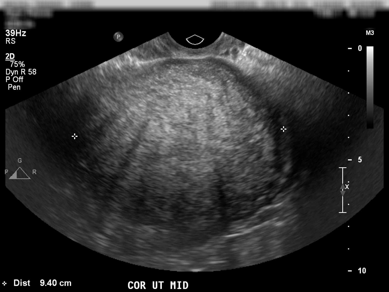 Uterine Adenomyosis - Body MR Case Studies - CTisus CT Scanning