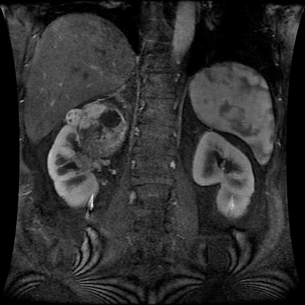 Renal cell carcinoma - CTisus CT Scan