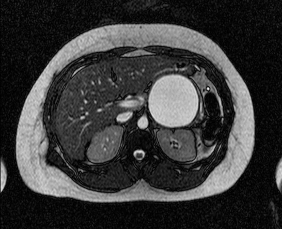 Mucinous cystic neoplasm (MCN) - CTisus CT Scan