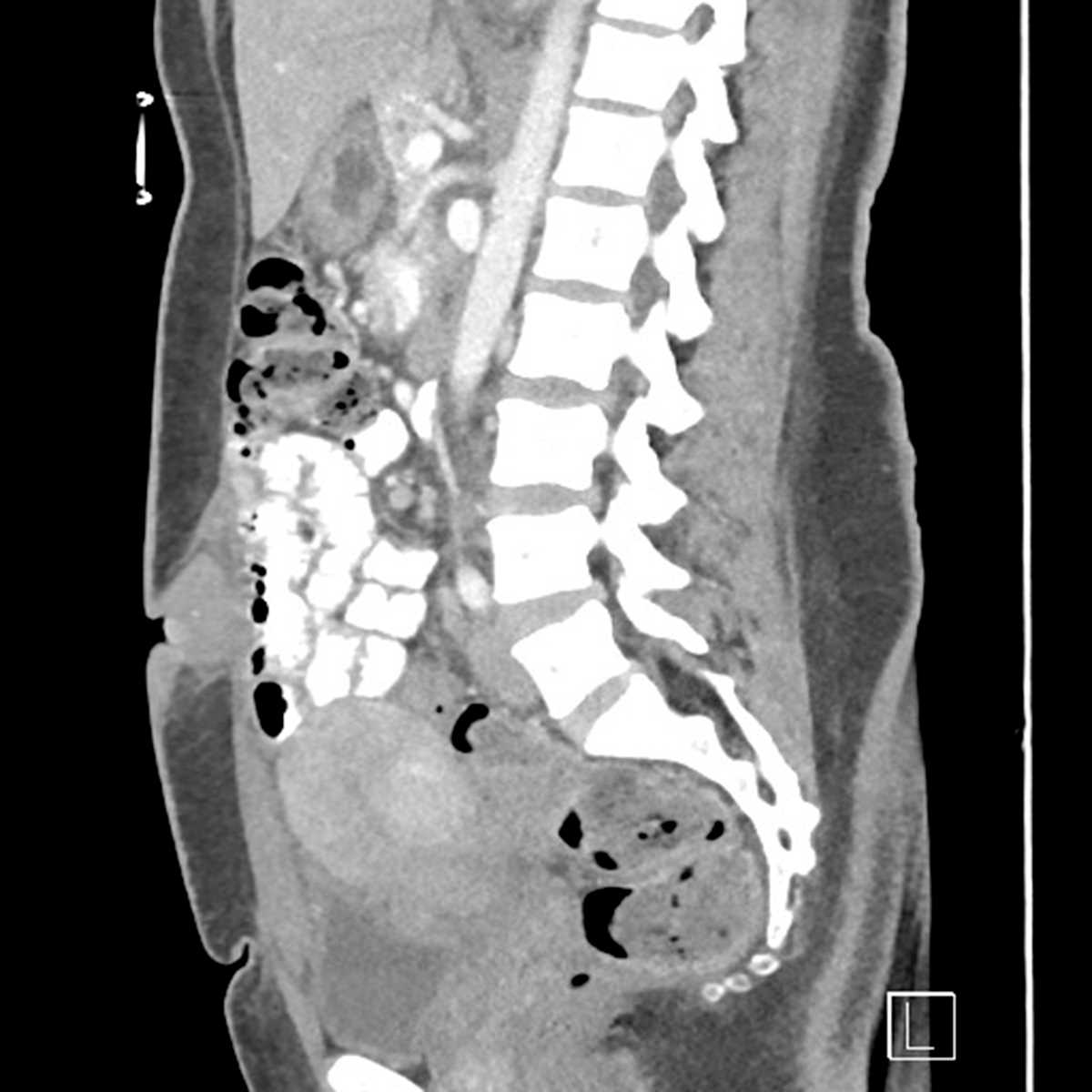 Scar Endometriosis - CTisus CT Scan