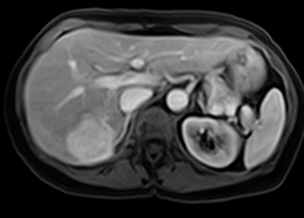 Focal nodular hyperplasia (FNH) - CTisus CT Scan