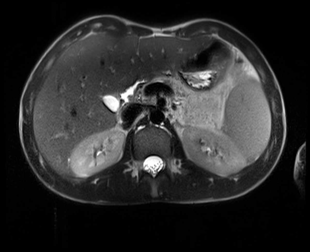 Cystic fibrosis with lipomatous pseudohypertrophy - CTisus CT Scan