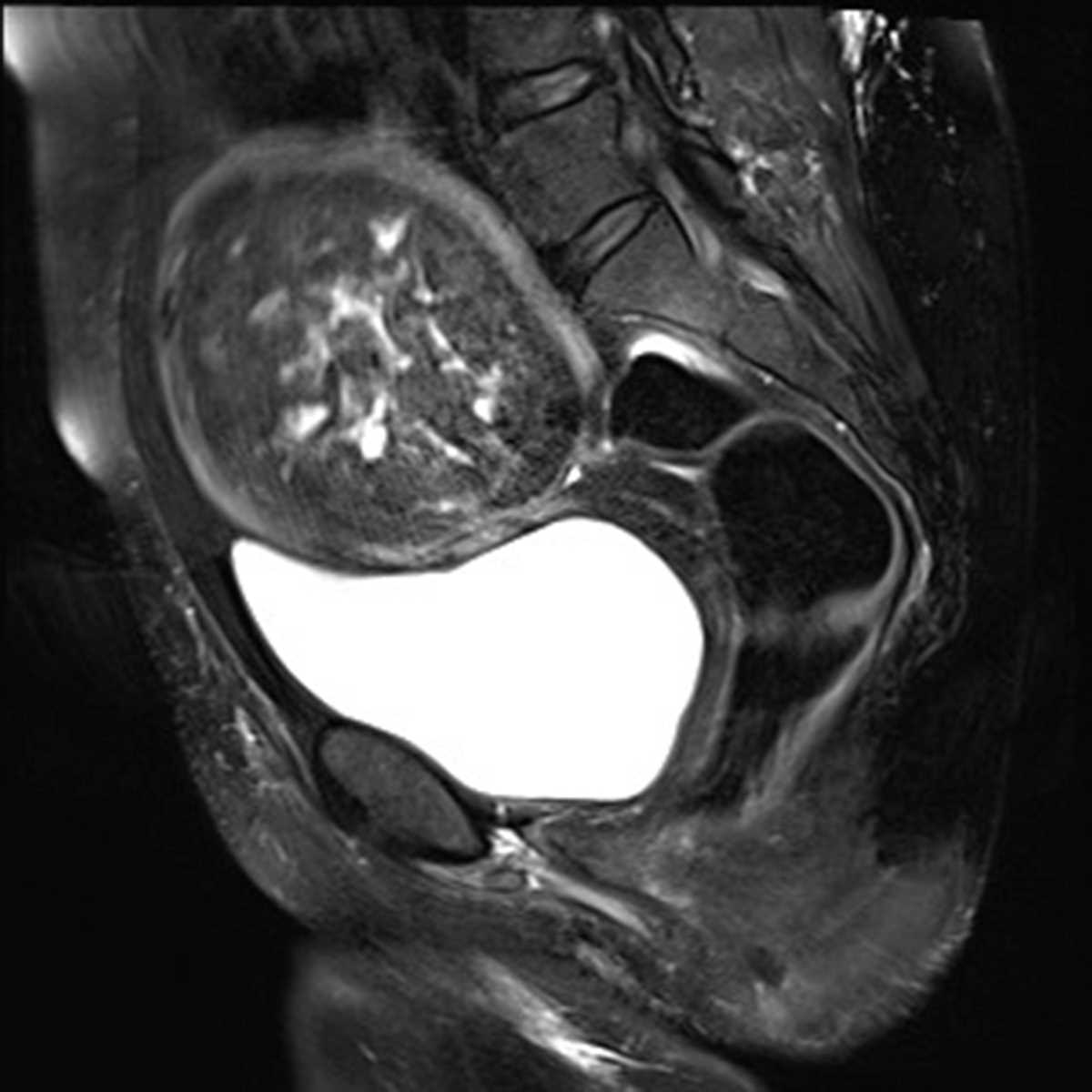 Uterine Fibroids 