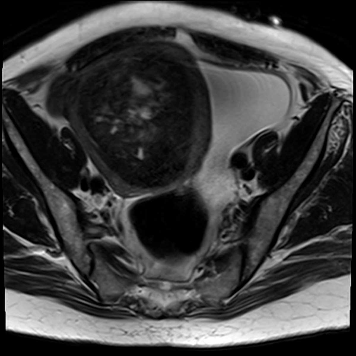 Uterine Fibroids Mri 