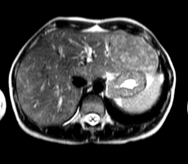 Focal Nodular Hyperplasia (FNH) - CTisus CT Scan