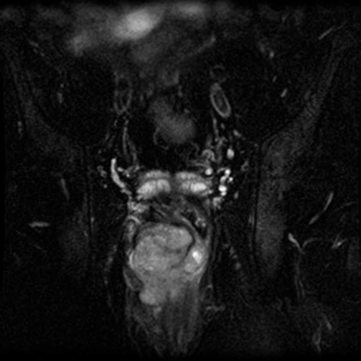 GIST Rectum - CTisus CT Scan