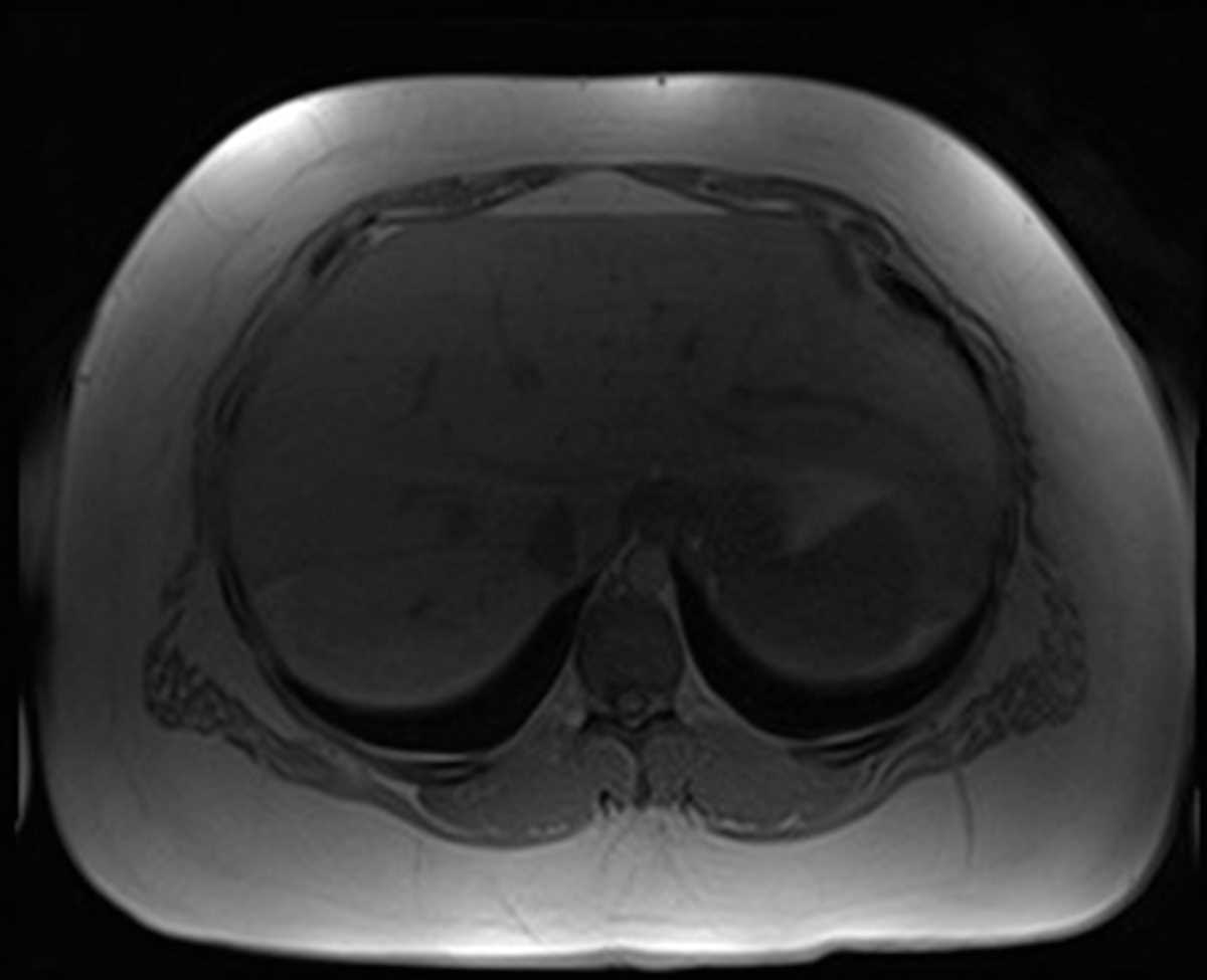 Hepatic Steatosis - CTisus CT Scan