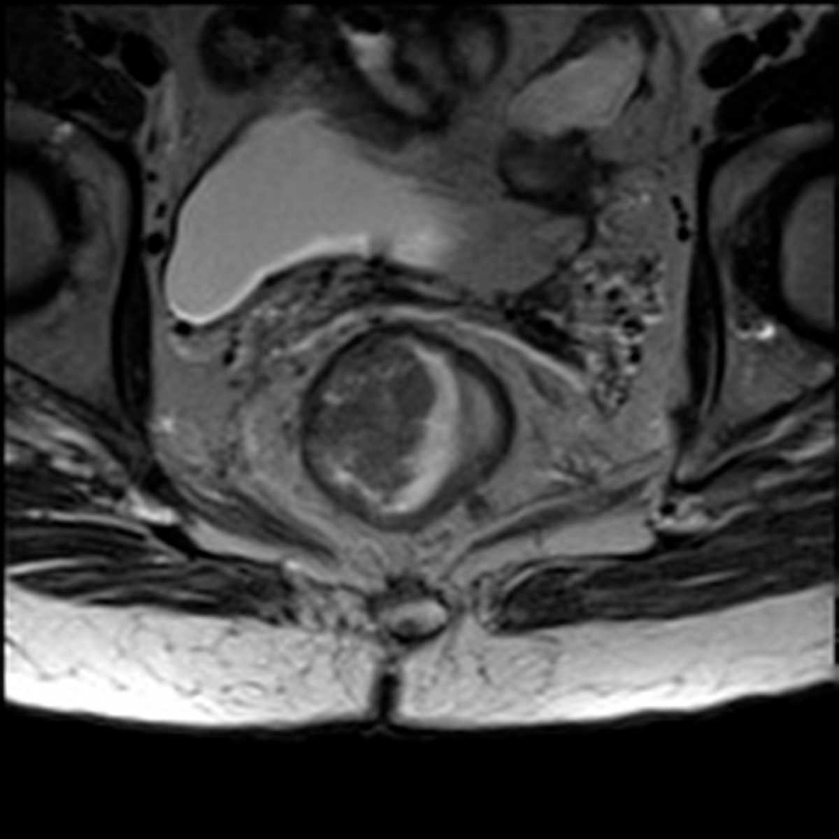 Rectal Cancer - CTisus CT Scan