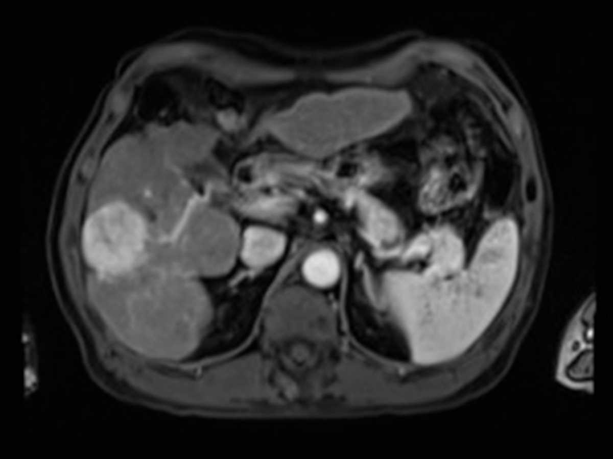 Hepatocellular Carcinoma (Hepatoma) (HCC) - CTisus CT Scan