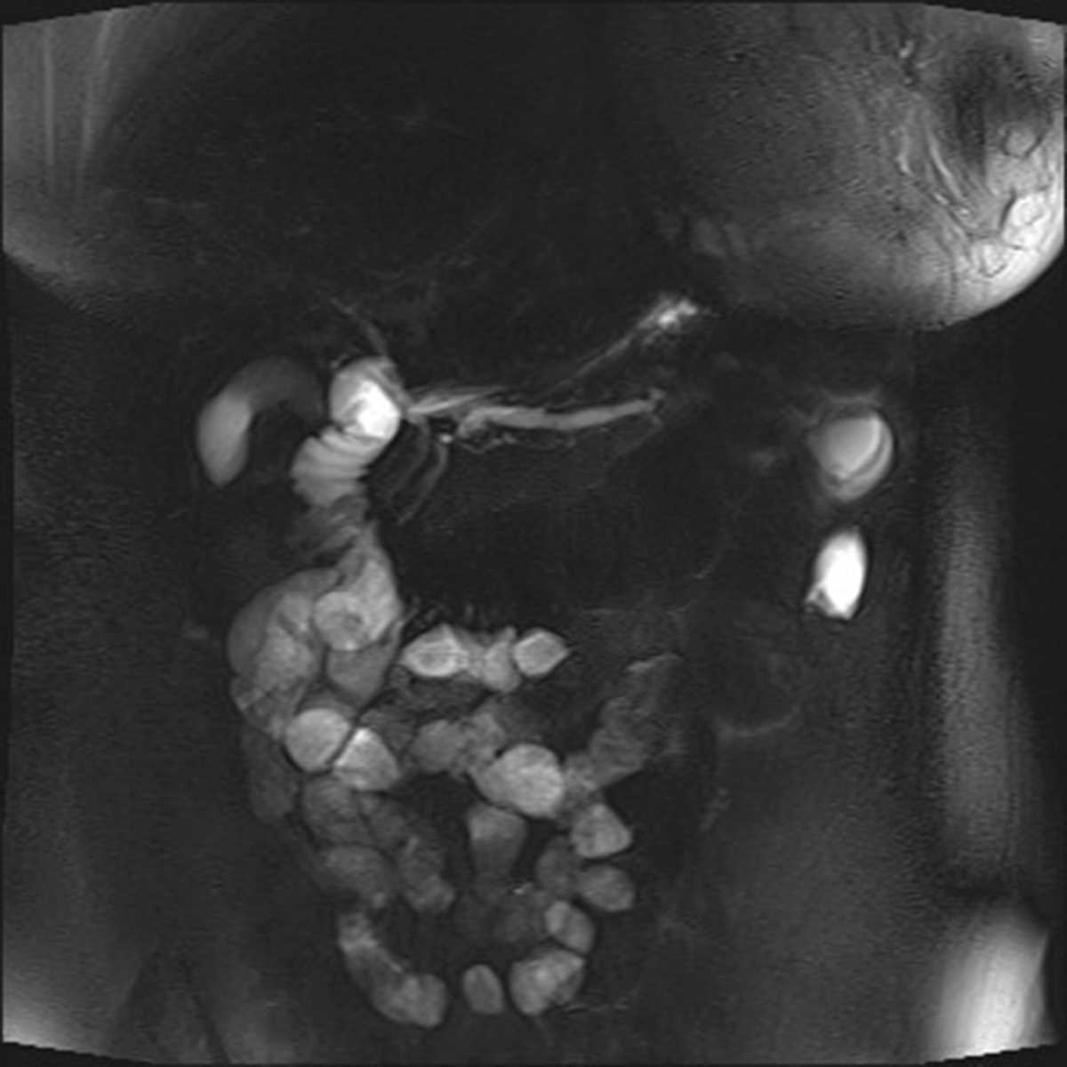 Benign Pancreatic Duct Stricture - CTisus CT Scan