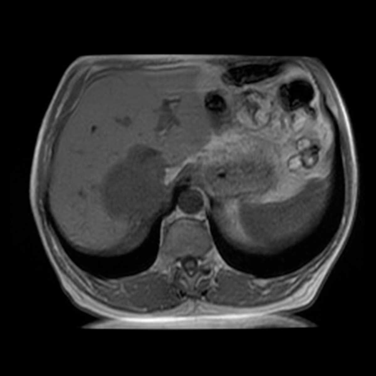 Retroperitoneal Liposarcoma - CTisus CT Scan