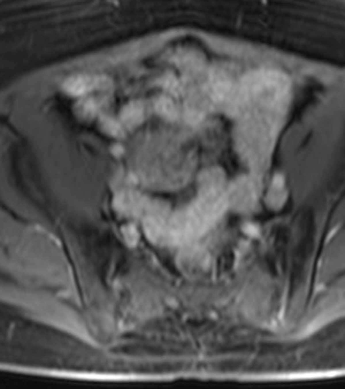 Sertoli-Leydig Cell Tumor of Ovary - CTisus CT Scan