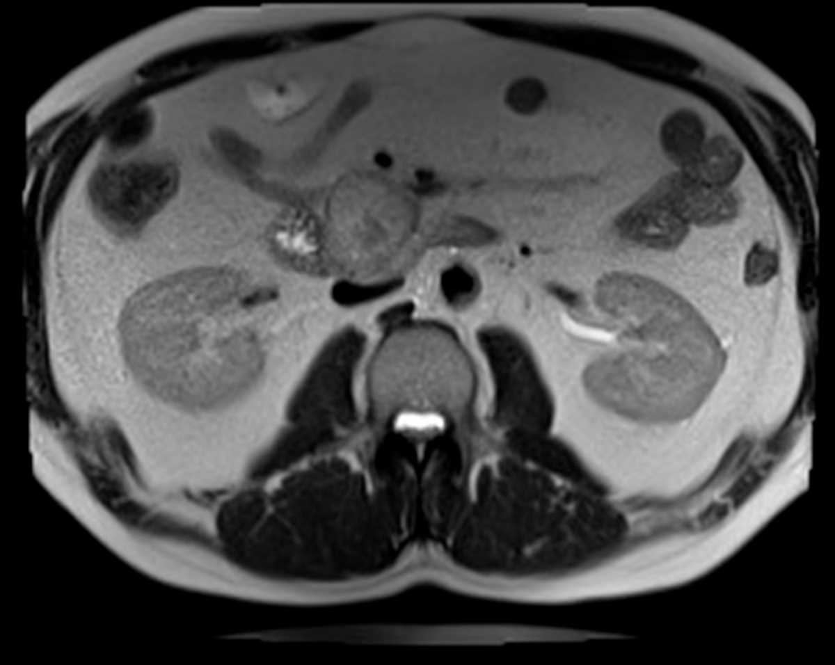 Duodenal GIST - CTisus CT Scan