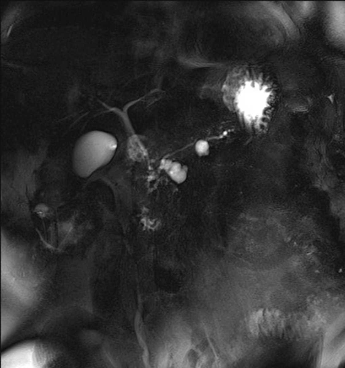 Side-branch Intraductal Papillary Mucinous Neoplasm (IPMN) - CTisus CT Scan