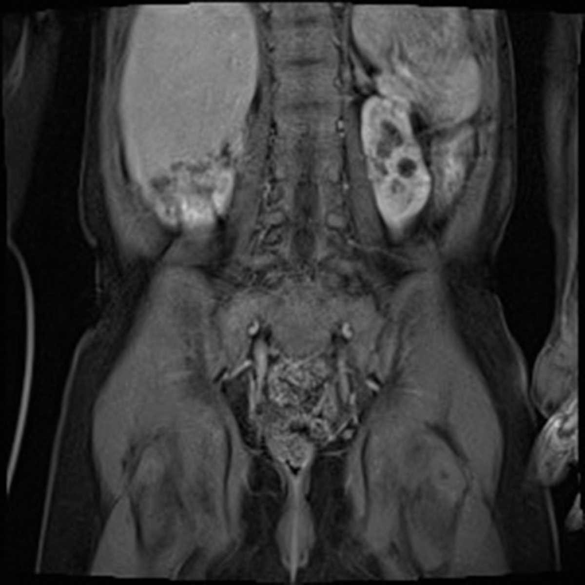 Crossed Fused Ectopia - CTisus CT Scan