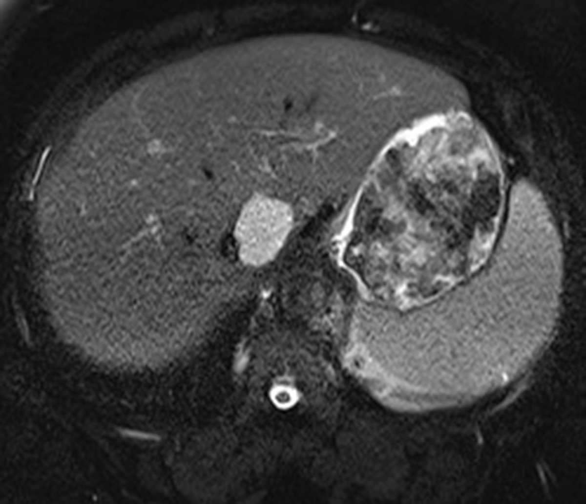 Hemangioma - CTisus CT Scan