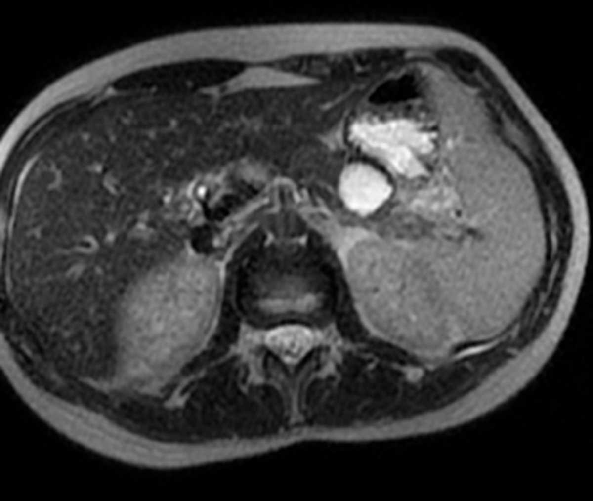 Mucinous Cystic Neoplasm - CTisus CT Scan