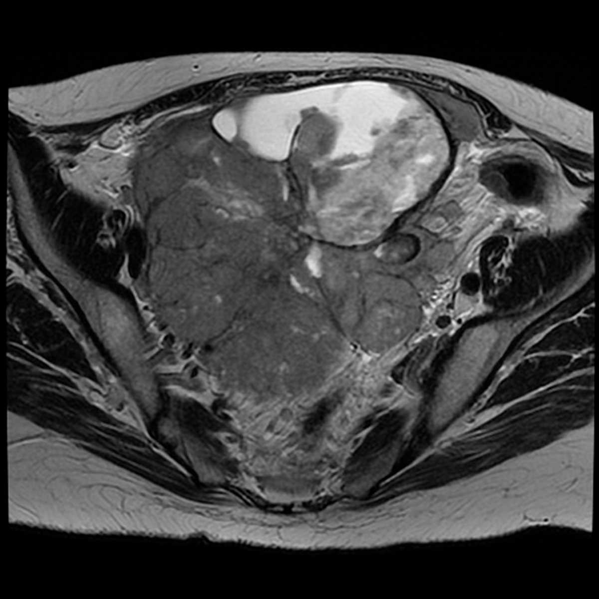 Ovarian Cancer - CTisus CT Scan