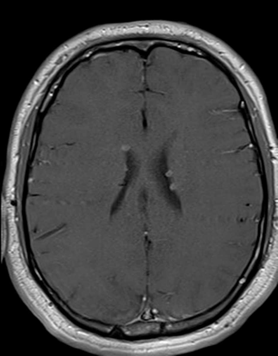 Tuberous Sclerosis - CTisus CT Scan